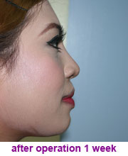 plastic_surgery_augmentation_rhinoplasty